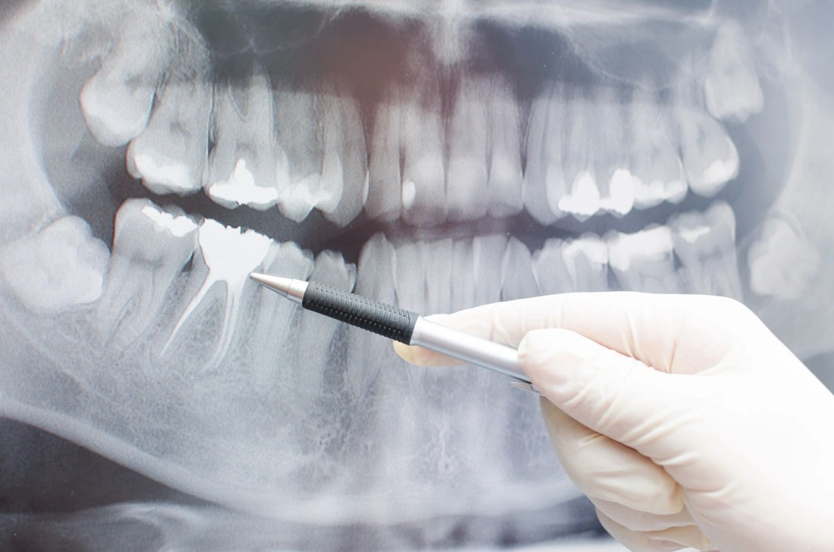 A dentist pointing to a digital dental X-ray